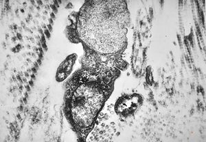 M, 10y. | Coffin-Lowry syndrome - skin